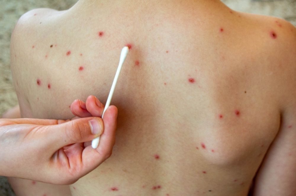 Sarampión en España: cómo los movimientos antivacunas están agrietando nuestro escudo sanitario